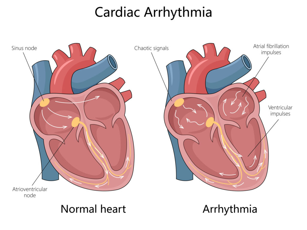 normal heart and cardiac arrhythmia diagram